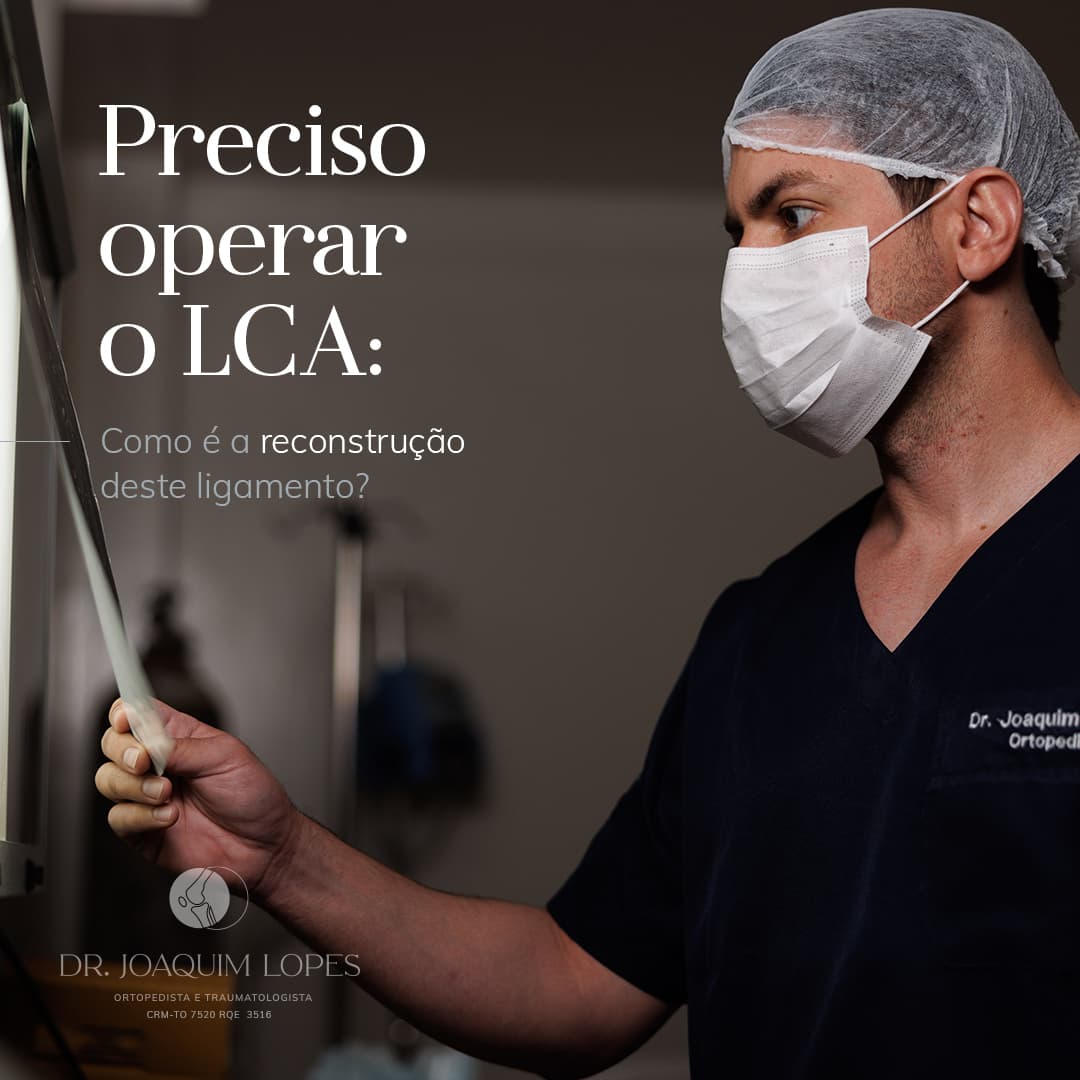 Preciso operar o LCA? Como é a reconstrução do ligamento